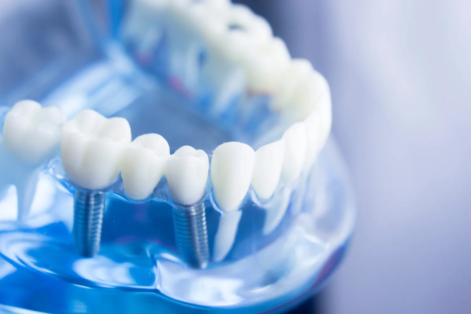 Implanty dentystyczne - czy mogą zastąpić prawdziwe zęby?
