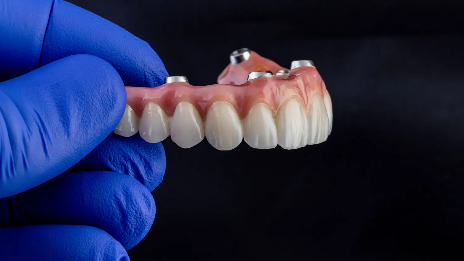 Dentysta Warszawa implanty