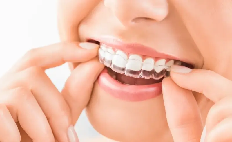 Invisalign kiedy pierwsze efekty?